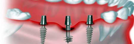 top-rated dental implant center in Dwarka: An Incredibly Easy Method That Works For All